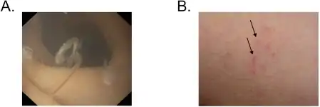 a) Adult hookworm b) inoculation site in person