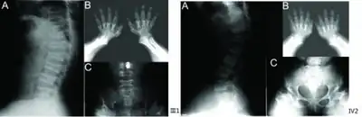 a) Anterior beaking of vertebral bodies b) short metacarpals and phalanges, cone-shaped epiphyses c) scoliosis, small femoral heads, flared metaphyseal borders