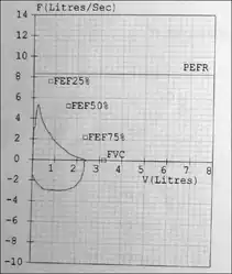 Tramadol-induced respiratory depression. Pulmonary function testing curves FVC  75% of predicted