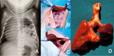 a)Posterolateral diaphragmatic hernia was discovered b) small bowel loops entering the thorax  c) after reducing contents  d)extreme left lung hypoplasia