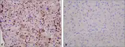 Liver biopsy staining a) Strong staining for hepatitis A antigen b) absent  (negative control )