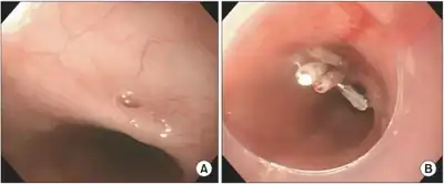 a) 3 mm-sized tracheoesophageal fistula  located in  esophagus about 33 cm from upper incisor b) endoscopic clipping was done by use of 4 clips