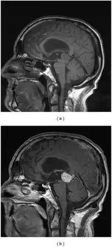 a,b)Parinaud's syndrome- sagittal and postcontrast sagittal images  pineocytoma compressing the midbrain tectum