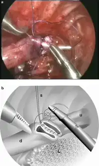 a) Thoracoscopic repair of esophageal atresia, b) picture  demonstrating the start of the anterior running suture