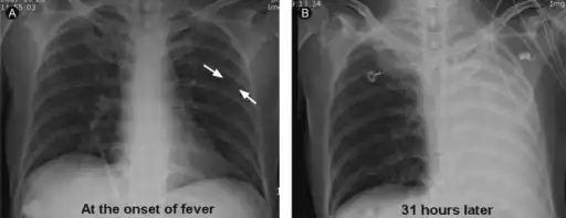 a) Subsegmental atelectasis  b) atelectasis had rapidly progressed the following day