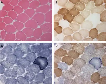 a-d)Abnormalities on skeletal muscle biopsy in mitochondrial myopathy