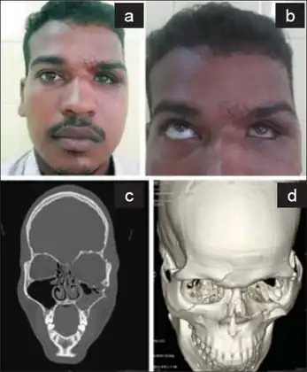 a)Enophthalmos and hypoglobus in left eye, b) restricted left eyeball movement in upward gaze, c) blow out fracture of left orbital floor  d) fracture and outward displaced left orbital floor