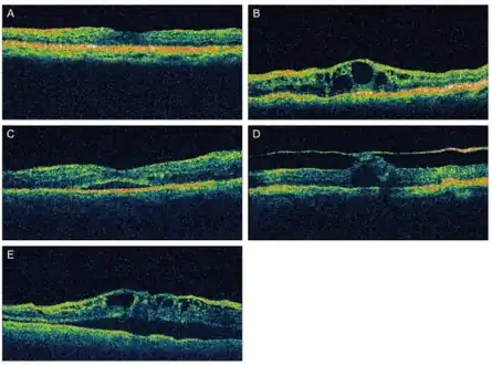 Different patterns of diabetic macular edema on optical coherence tomography a) Diffuse type of macular edema b) cystoid type of macular edema c) serous type of macular edema  d) vitreomacular tractional type of macular edema e) mixed type of macular edema.