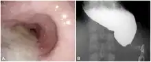 a) Dilatation in the middle esophagus  b) achalasia with esophageal dilatation