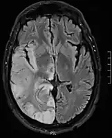 Hemispheric gyriform hyperintense signal variations