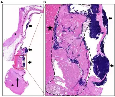 a,b)Stained section of vegetative lesions on aortic valves characteristic of staphylococcal endocarditis