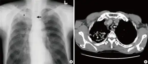 a)Image reveals tuberculosis asterisk b) CT scan of the chest shows  tuberculosis with cavitation asterisk