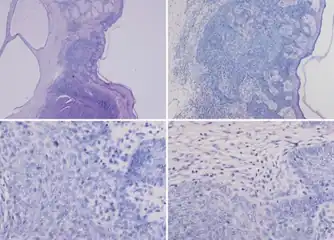 Images- Tumor of follicular infundibulum