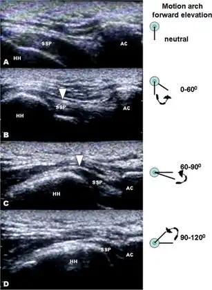 Dynamic musculoskeletal sonography of individual with shoulder impingement syndrome after receiving hook plate fixation of  left distal clavicle fracture