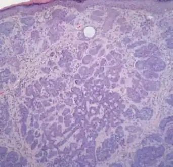 Trichoblastoma