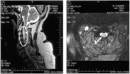 a,b)MRI of  cervical spinal cord of individual with bilateral upper extremity paralysis and respiratory failure from West Nile poliomyelitis