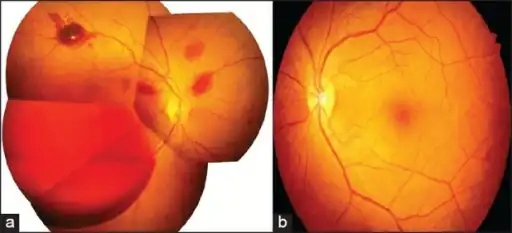 a) Right fundus  with grade-1 hypertensive retinopathy changes (and subhyaloid hemorrhage)  b) left fundus showing grade-1 hypertensive retinopathy changes (with absence of intraocular hemorrhages)