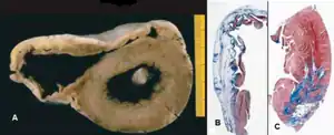 Arrhythmic cardiomyopathy pathology  a) Right ventricular dilatation, anterior and posterior wall aneurysms b) transmural fibrofatty replacement c)focal subepicardial left ventricular involvement