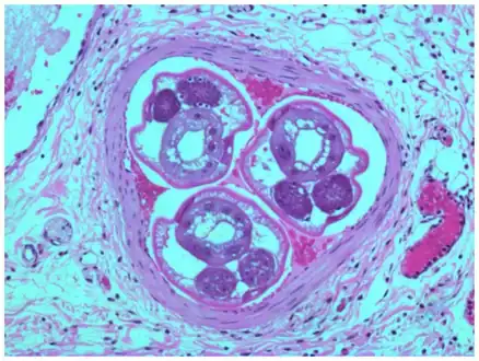 Angiostrongylus costaricensis inside mensenteric artery