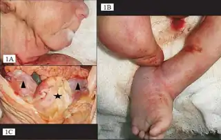 a) Hypoplastic mandible b)hypoplasia of right lower limb  c) dilated urinary bladder  asterisk and bilateral hydroureters arrowheads