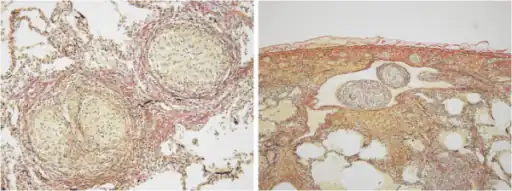 The findings are consistent with hypersensitivity pneumonitis with poor drainage of a large amount of granulomas