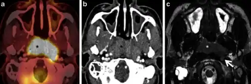 a) Axial PET/CT image reveals a FDG-avid mass in the nasopharynx in keeping with a known nasopharyngeal carcinoma  b)axial CECT image shows the infiltrative nasopharyngeal carcinoma c) axial T2W MR image demonstrates the infiltrative nasopharyngeal carcinoma