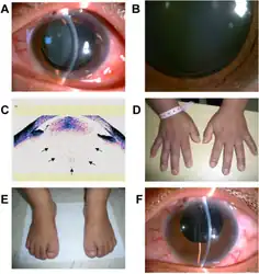 a) Small lens, b)  suspensory ligaments,   c)lens is microspherophakic, d) &  e), short toes/fingers ,f) phacoemulsification and intraocular lens implantation.