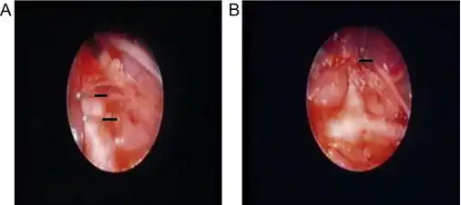 a) Right-sided aortic arch with abberant left subclavian artery – clipped b) right-sided aortic arch with abberant left subclavian artery – divided