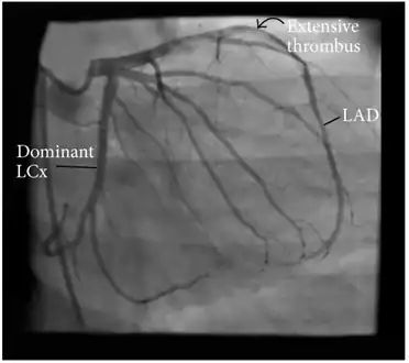 Angiographic image showing extensive LAD thrombosis