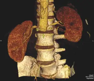 Bilateral renal artery stenosis asterisk (Absent infra-renal aorta arrow)