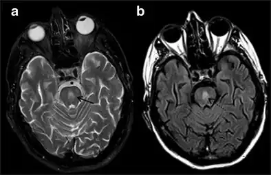 Central Pontine Myelinolysis -a & b) axial T2W and FLAIR images at the level of pons show central pontine hyperintensity