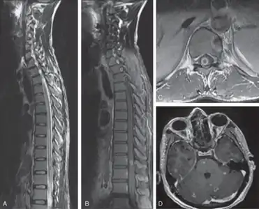 Myeloradiculopathy in tuberculous meningitis-a) Long segment myelitis b,c) intramedullary tuberculoma at D10 level d)multiple tuberculoma involving cerebrum, cerebellum, and brainstem