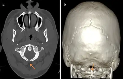 a,b) Atlas spina-bifida oculta