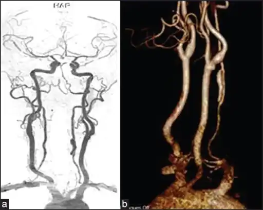 Vertebral artery dissection with focal dilatation of  involved segment