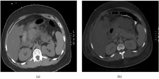 Pegaspargase induced hypertriglyceridemia a) Enlarged pancreas with peripancreatic inflammation b) Interval worsening of acute pancreatitis