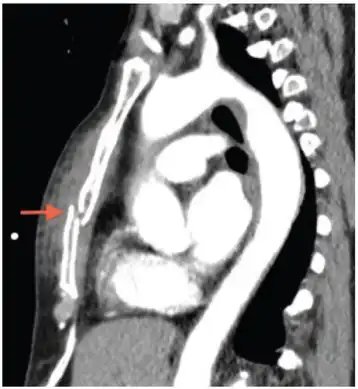 Computed tomography identifying  displaced sternal fracture.