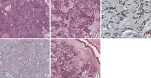 Malignant adenomyoepithelioma of the breast