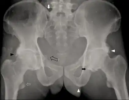 Individual with idiopathic hypoparathyroidism-diffuse osteosclerosis, capsular ossification around bilateral hip joints arrow, ossification of bilateral iliolumbar ligaments  arrow, irregular bony excrescences arrowhead, subtle calcification of the right sacrospinous ligament open arrow