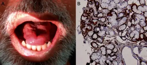 a)Tongue atrophy due to transthyretin-related familial amyloid polyneuropathy(synonym ) b)minor salivary gland biopsy