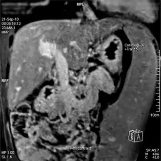 Magnetic resonance imaging of portal hypertension