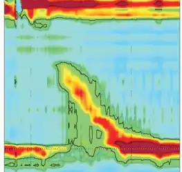 Esophageal high-resolution manometry (HRM) findings - Esophagogastric junction outflow obstruction. HRM shows preserved esophageal body peristalsis but elevated integrated relaxation pressure