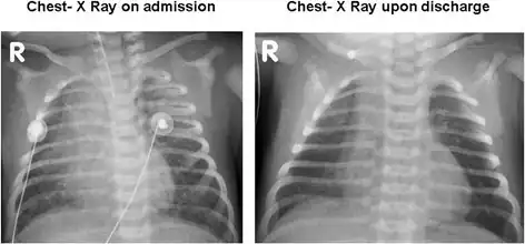 Bilateral patchy infiltrates due to pulmonary hemorrhage on admission and resolution upon discharge.