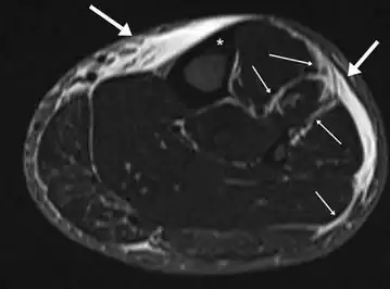 MRI of the left lower leg-severe “shin-splint”