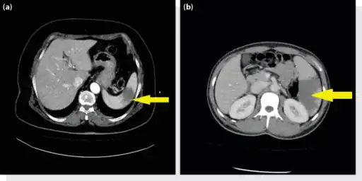 a, b) Splenic infarction.