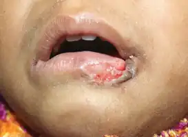 Injured lip