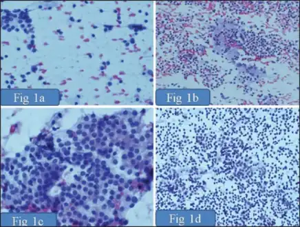 a) Grade 1 thyroiditis characterized by presence of increased number of lymphocytes b) Grade 2 thyroiditis shows the presence of Hurthle cells, epithelioid cells, giant cells, and anisonucleosis c) Grade 2 thyroiditis shows the presence of Hurthle cells with lymphocytic infiltration d) Grade 3 thyroiditis characterized by presence of florid lymphocytic infiltration