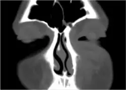 Marked left facial edema due to periorbital cellulitis following a dental procedure.