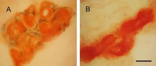 Sweat gland innervations in familial amyloid polyneuropathy a) control b)sweat gland innervation markedly reduced in FAP