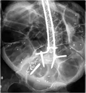 Radiograph of abdomen, of  individual  with Duchenne muscular dystrophy, spine stabilization is achived via rods and screws (one is displaced) and a Percutaneous endoscopic gastrostomy is visible