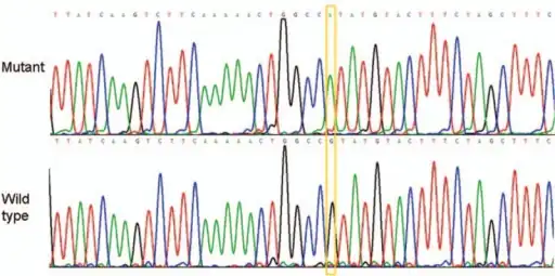 BMD (Becker muscular dystrophy) exon/intron 15, base change c,1812+1G>A